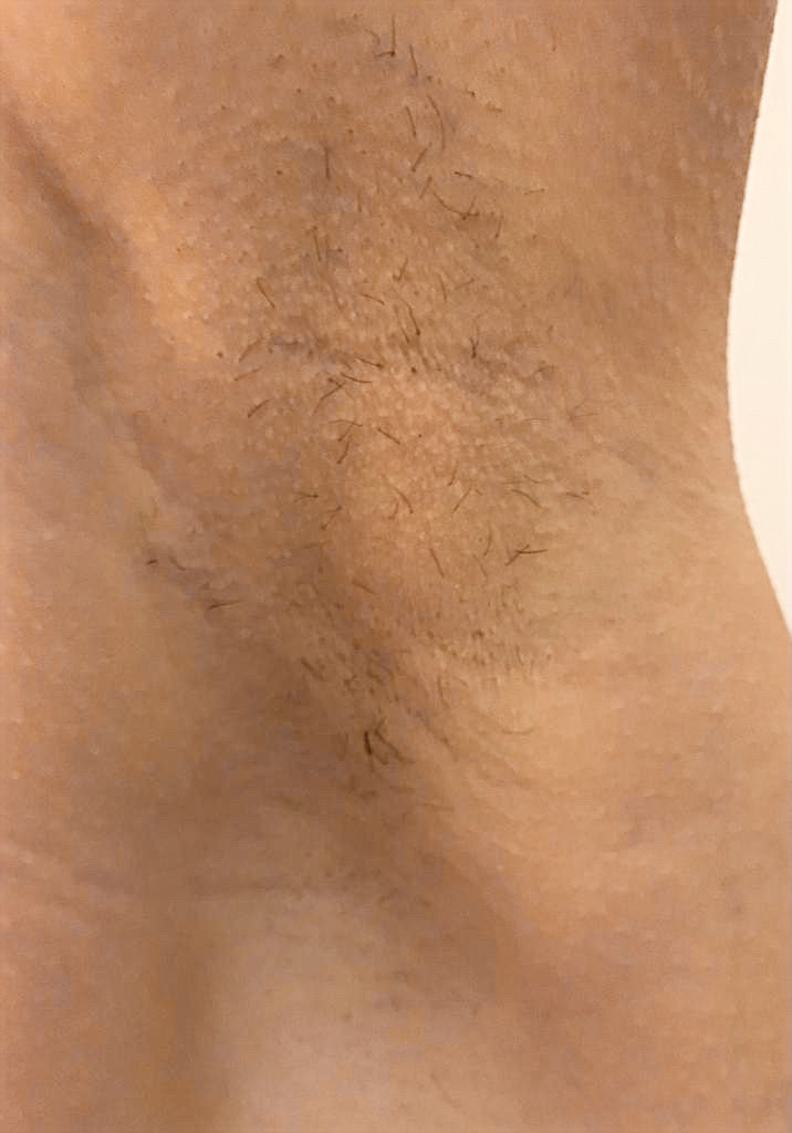 Bild nach der 2. Behandlung mit der Adéna - IPL dauerhafte Haarentfernung
