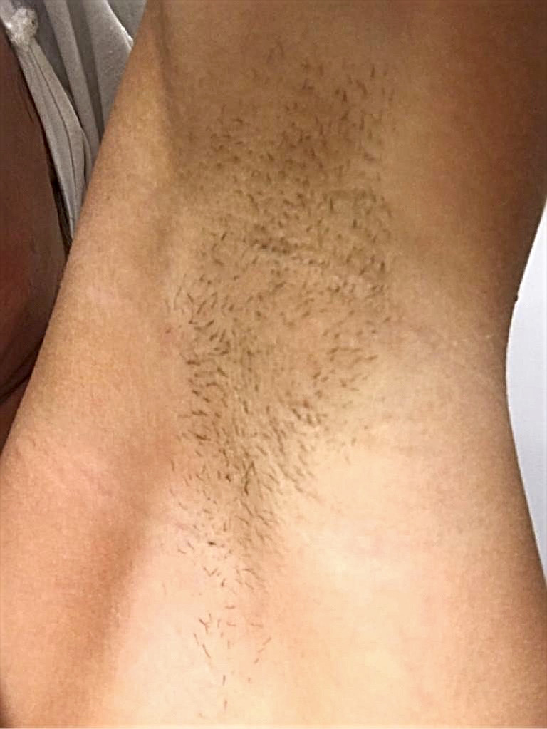 Bild vor der Behandlung mit der Adéna - IPL dauerhafte Haarentfernung